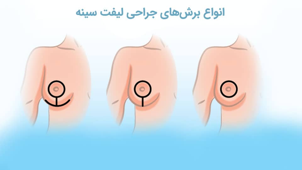 انواع برش جراحی لیفت سینه
