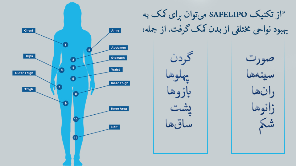نواحی لیپوساکشن