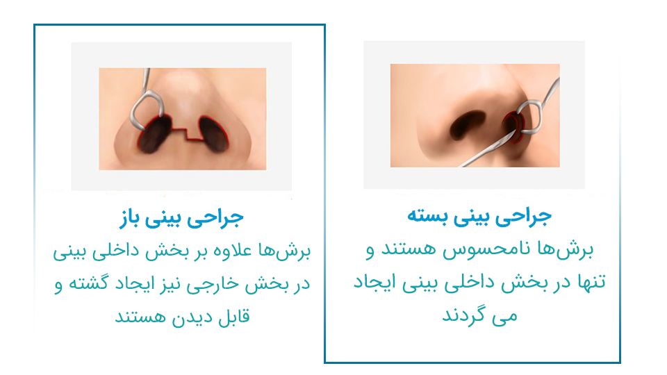 تفاوت جراحی بینی بسته و باز