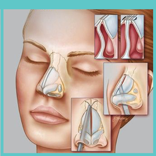 درمان انحراف بینی با جراحی