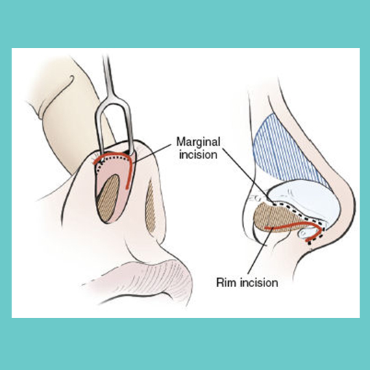 برش ها در جراحی بینی
