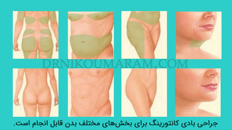 بادی کانتورینگ