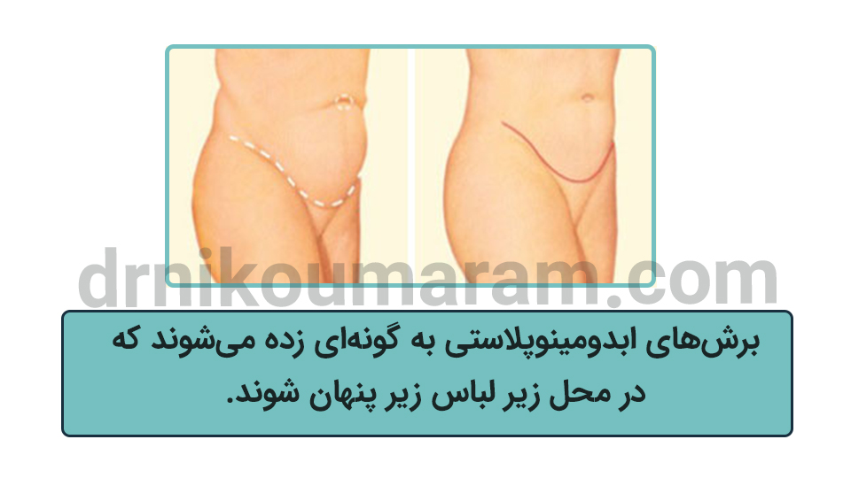 جراحی زیبایی شکم
