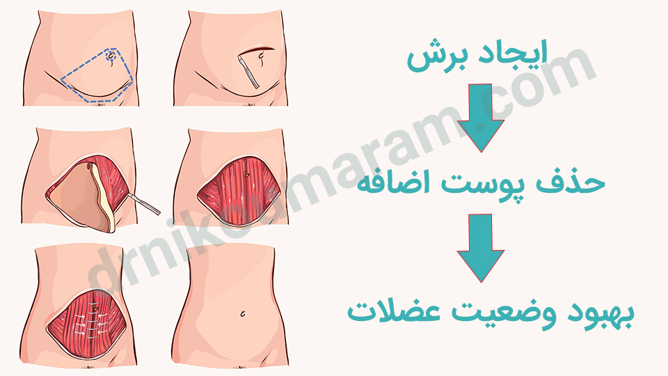 روند ابدومینوپلاستی