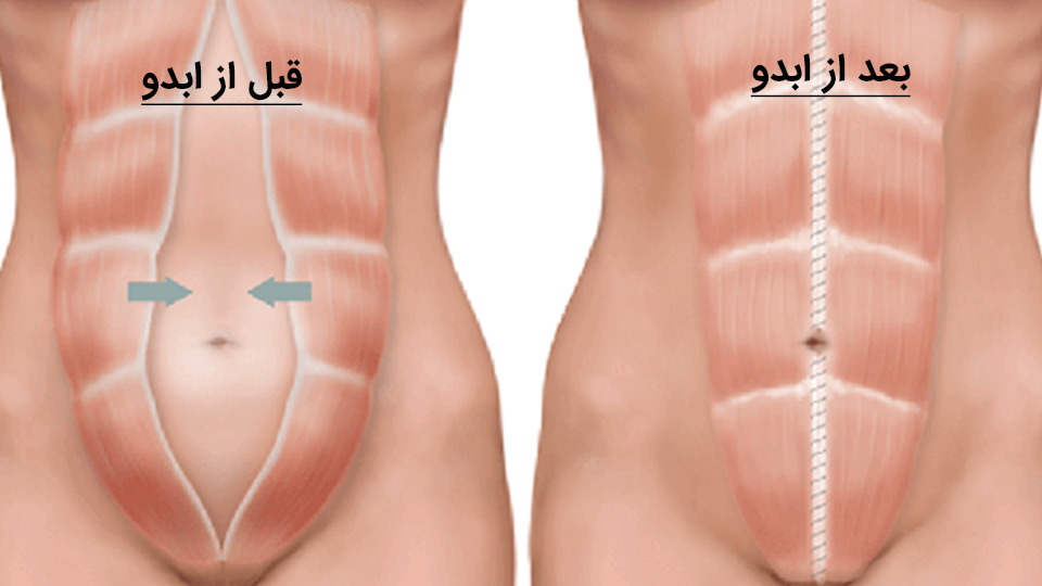 قبل و بعد از ابدومینوپلاستی