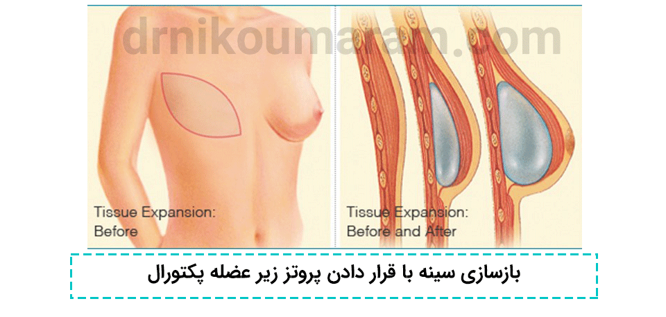 بازسازی سینه با قرار دادن پروتز زیر عضله