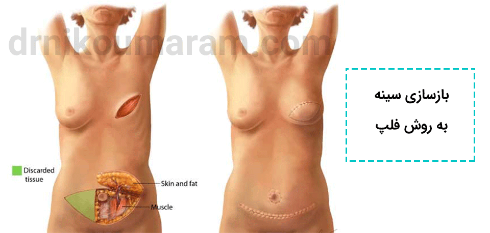 بازسازی سینه به روش فلپ