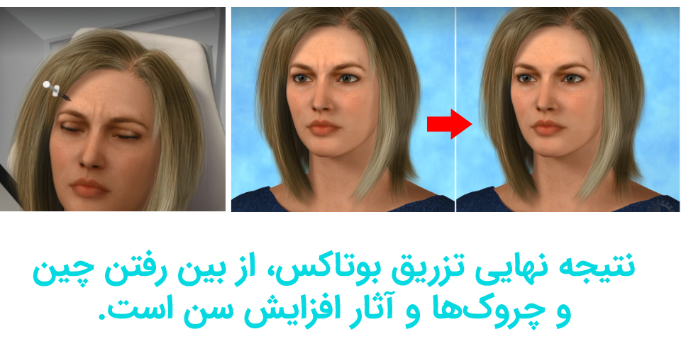 نتیجه تزریق بوتاکس