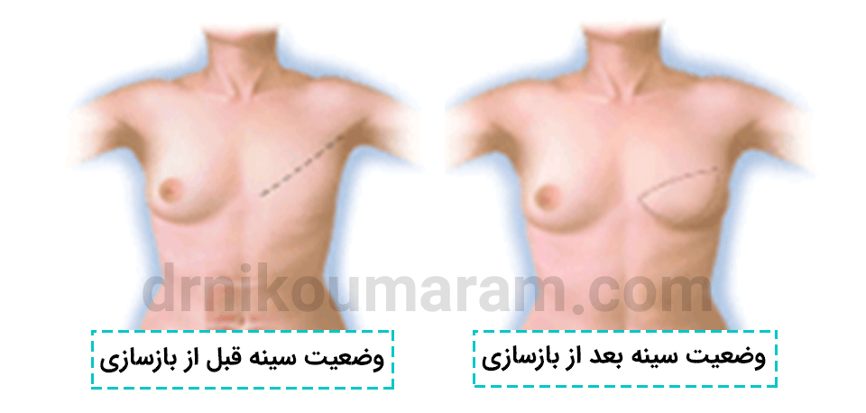 نتیجه عمل بازسازی سینه