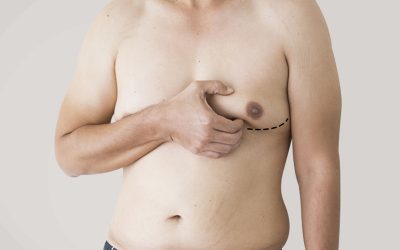 ژنیکوماستی