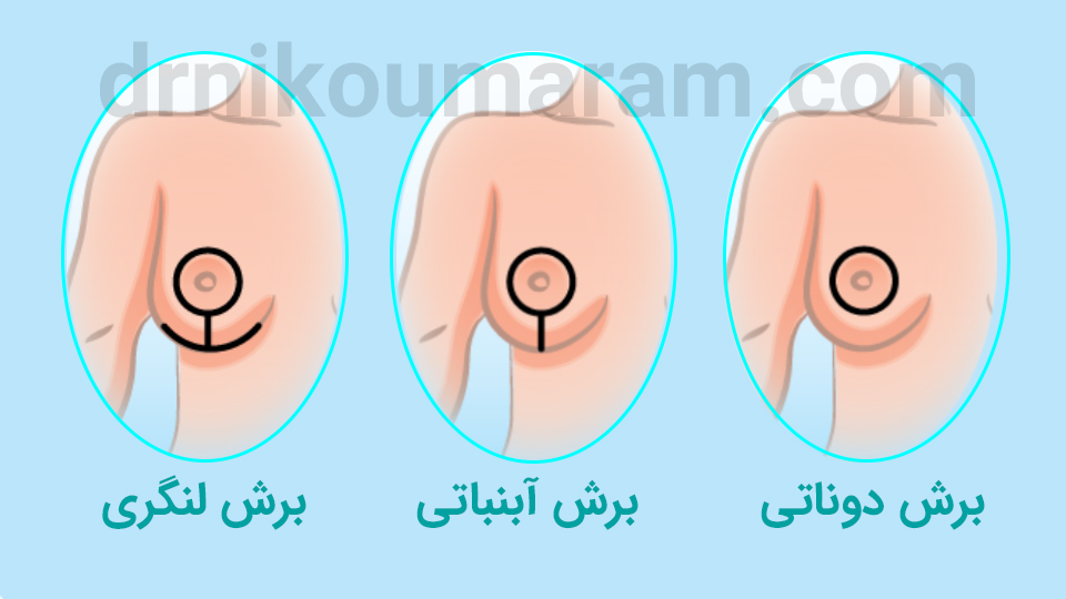 برش های ماموپلاستی