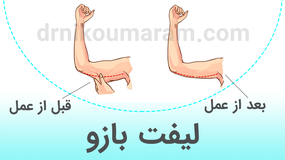عمل لیفت بازو