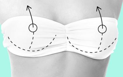 ماموپلاستی (عمل کوچک کردن سینه)