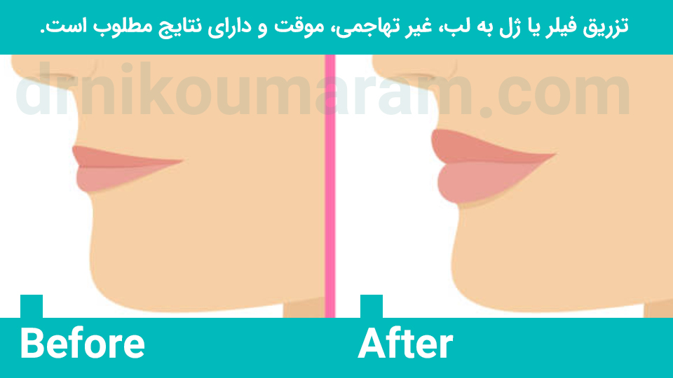 تزریق ژل لب