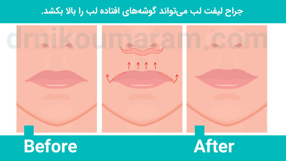 جراحی لیفت لب