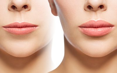 راه های مختلف لیفت لب کدامند؟ مزایا و معایب هر یک چیست؟