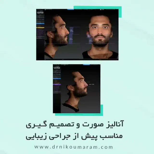 آنالیز صورت قبل از جراحی زیبایی