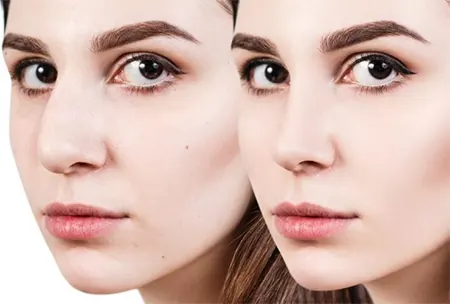 کاندیدای جراحی بینی گوشتی