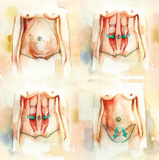 مراقبتهای ضروری پس از جراحی ابدو