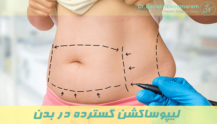 لیپوساکشن گسترده در بدن 
