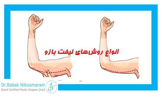 انواع روشهای لیفت بازو