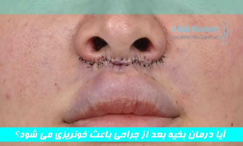 آیا درمان بخیه بعد از جراحی باعث خونریزی می شود؟