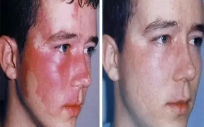 درمان سوختگی پوست و ترمیم و بازسازی جای سوختگی